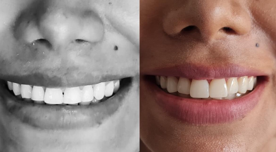 Antes y después · diseño de sonrisa con carillas de resina