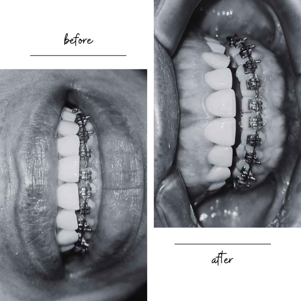 Antes y después · ortodoncia con brackets